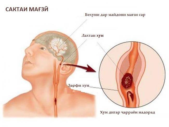 Аввалин нишонаҳои сактаи мағзӣ: То омадани мошини ёрии таъҷилӣ чӣ бояд кард?